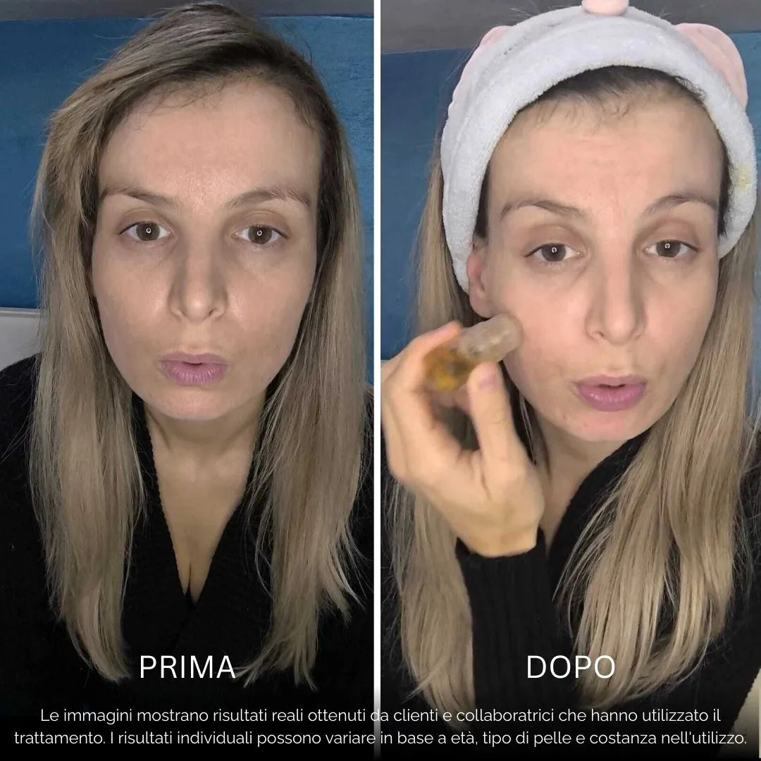 BioInfusion+ | Sistema di Microinfusione (Dear Alice)