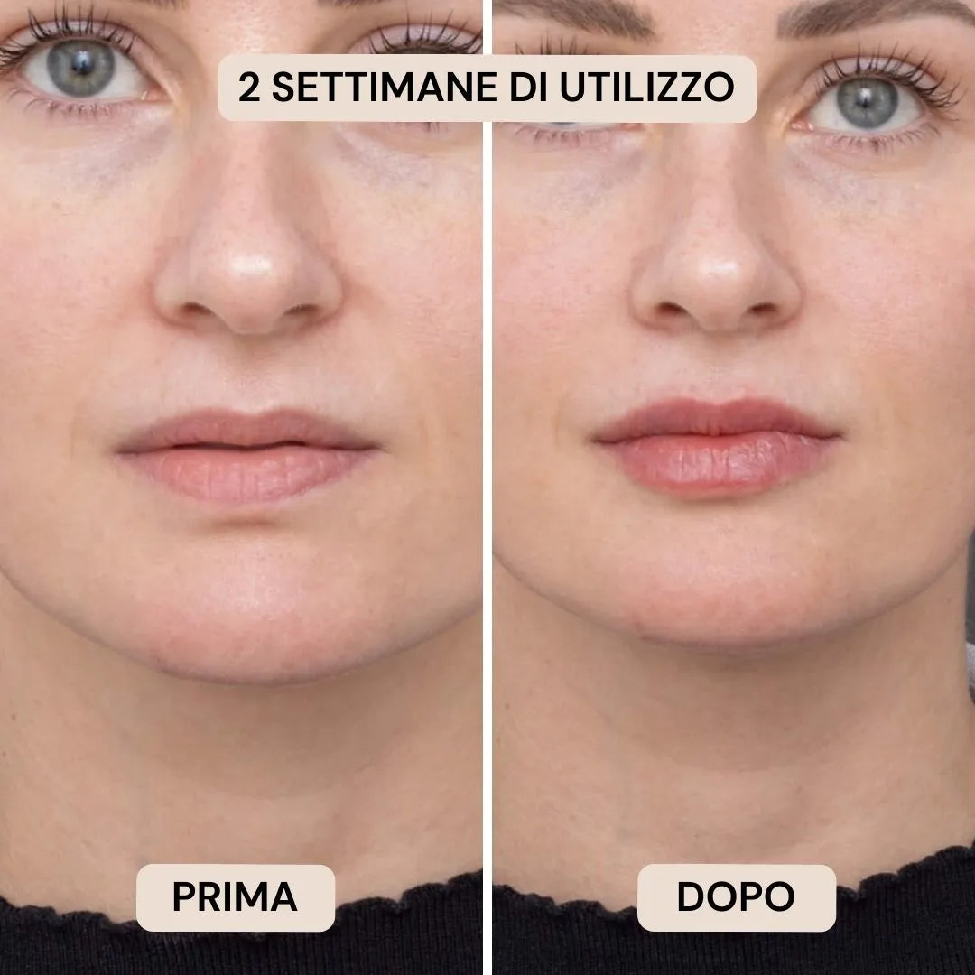 BioVolume+ | Microinfusione Labbra