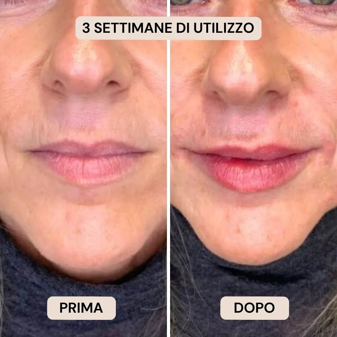 BioVolume+ | Microinfusione Labbra