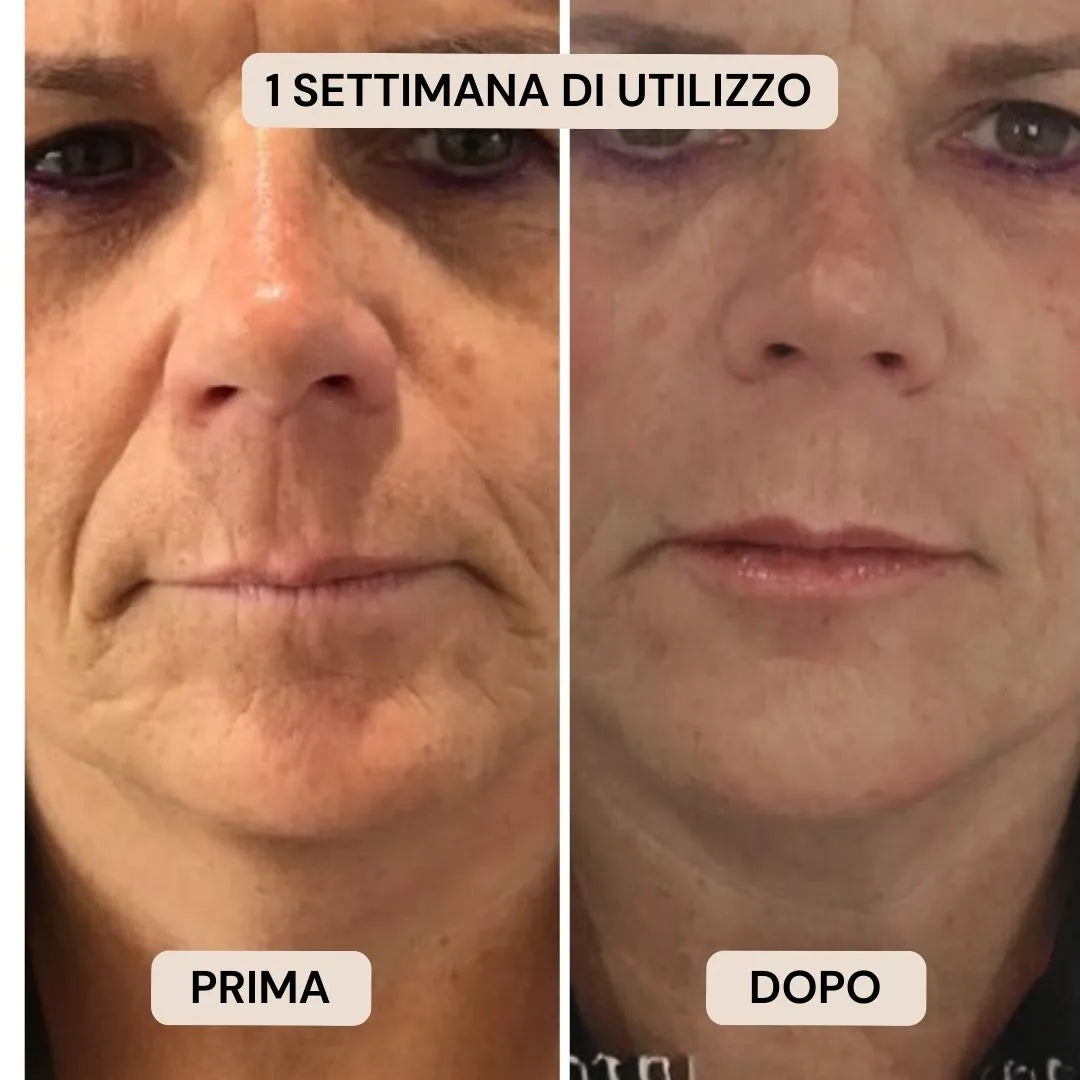 BioVolume+ | Microinfusione Labbra