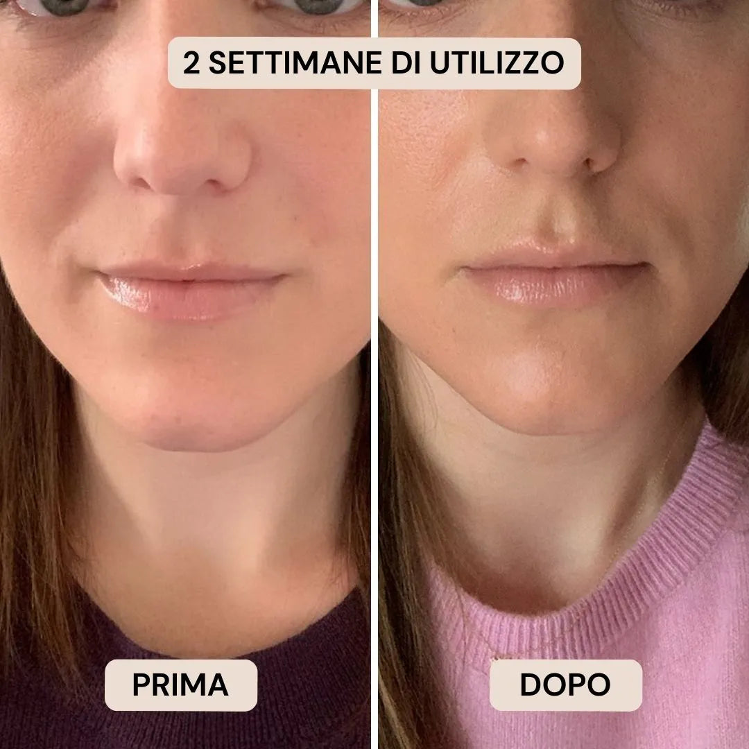 BioVolume+ | Microinfusione Labbra