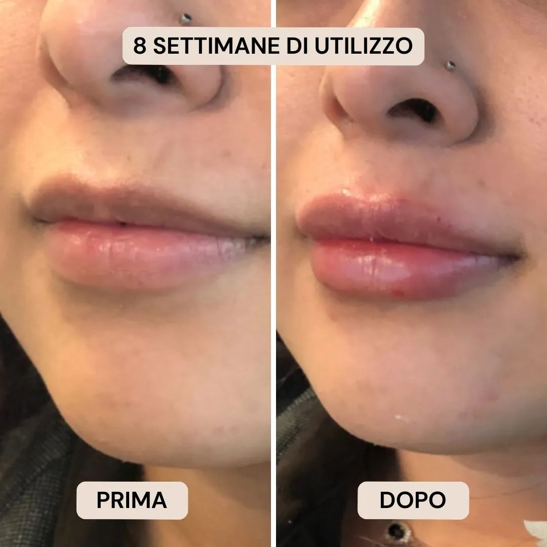 BioVolume+ | Microinfusione Labbra