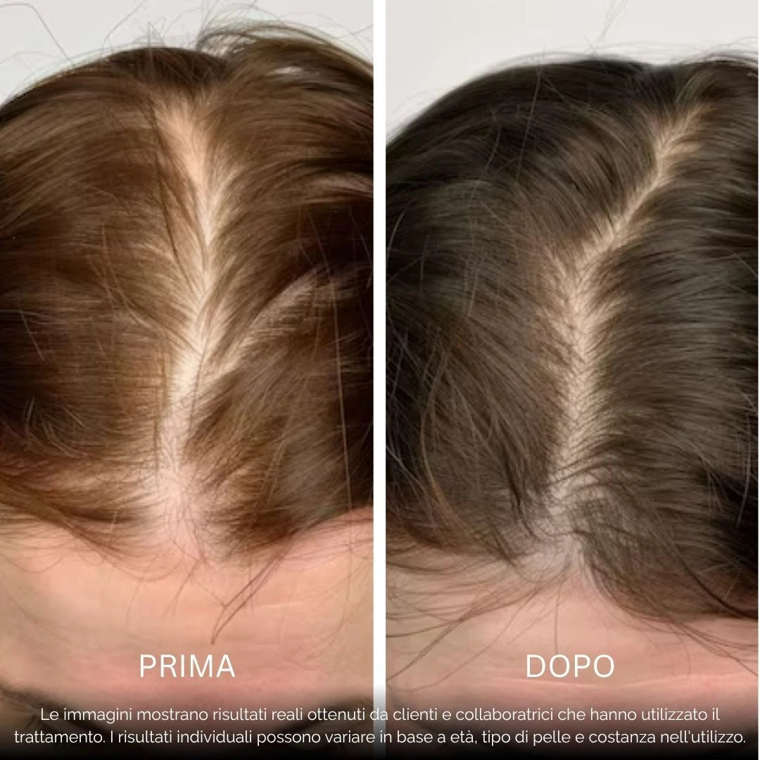 BioDensity+ | Sistema di Microinfusione Capelli