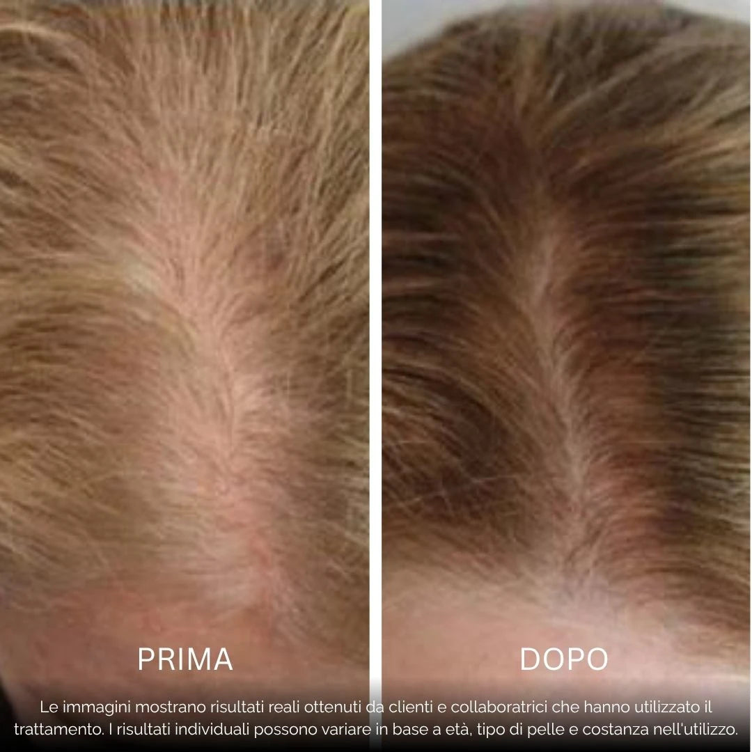 BioDensity+ | Sistema di Microinfusione Capelli