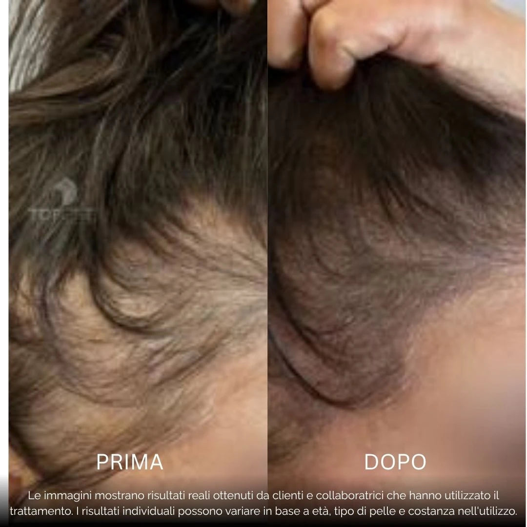 BioDensity+ | Sistema di Microinfusione Capelli