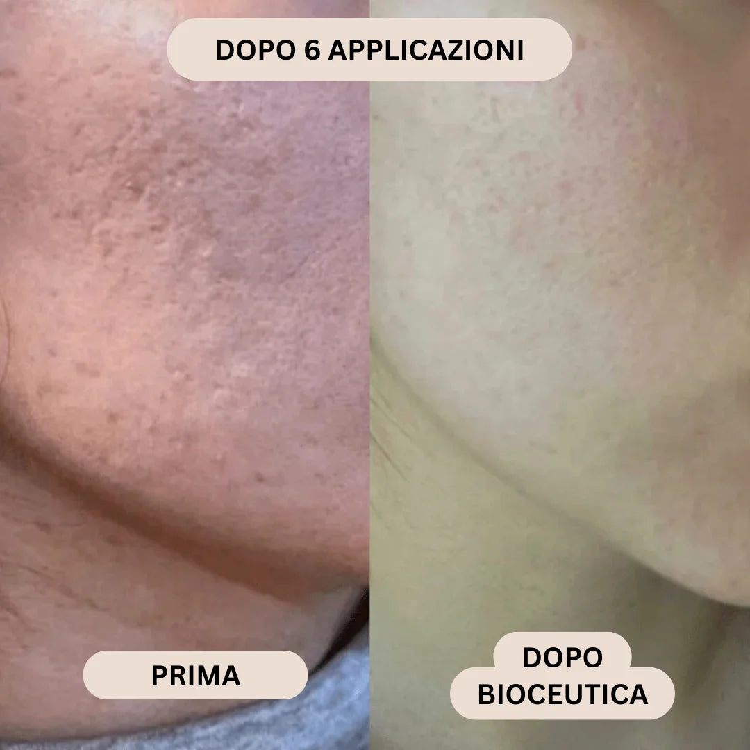 BioInfusion+ | Sistema di Microinfusione