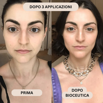 BioInfusion+ | Sistema di Microinfusione