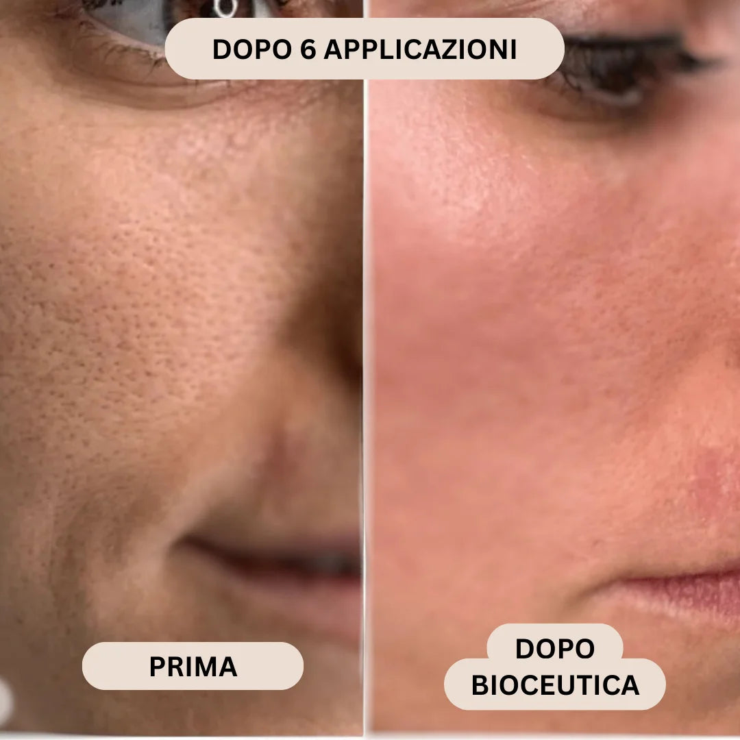 BioInfusion+ | Sistema di Microinfusione