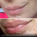 BioVolume+ | Microinfusione Labbra