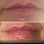 BioVolume+ | Microinfusione Labbra