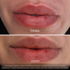 BioVolume+ | Microinfusione Labbra