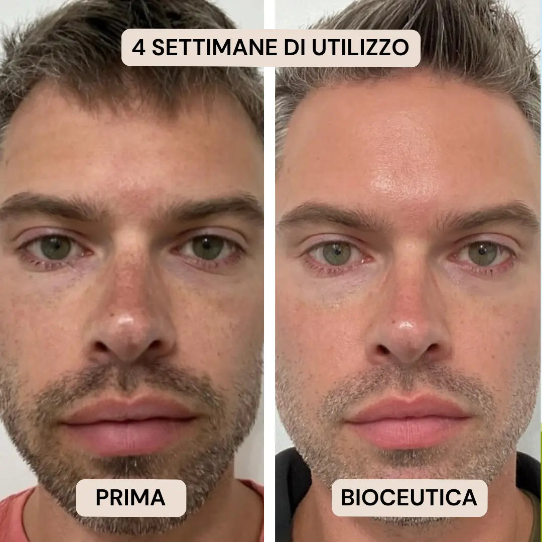 BioInfusion+ | Sistema di Microinfusione (Uomo)