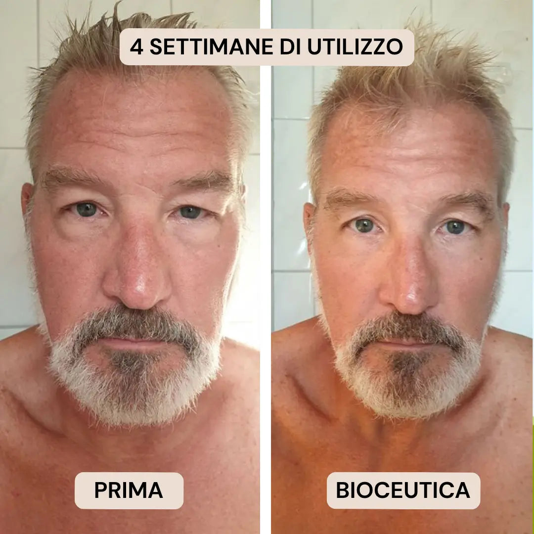 BioInfusion+ | Sistema di Microinfusione (Uomo)
