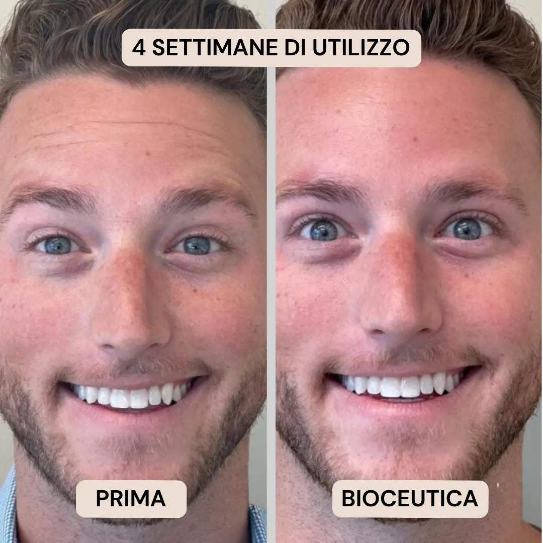 BioInfusion+ | Sistema di Microinfusione (Uomo)