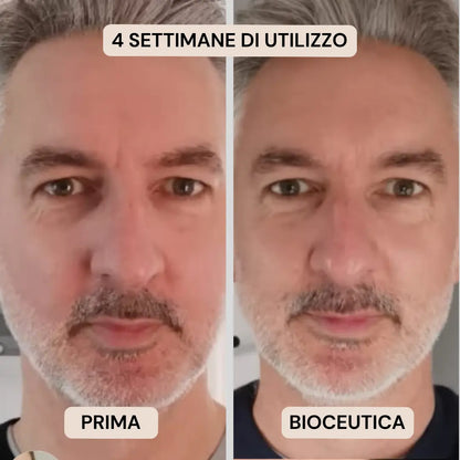 BioInfusion+ | Sistema di Microinfusione (Uomo)