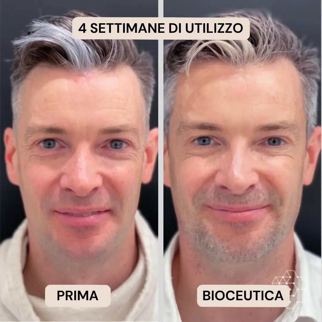 BioInfusion+ | Sistema di Microinfusione (Uomo)