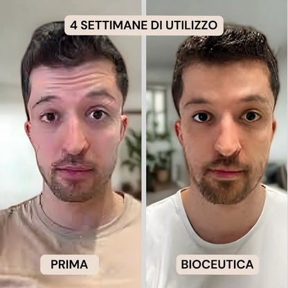 BioInfusion+ | Sistema di Microinfusione (Uomo)
