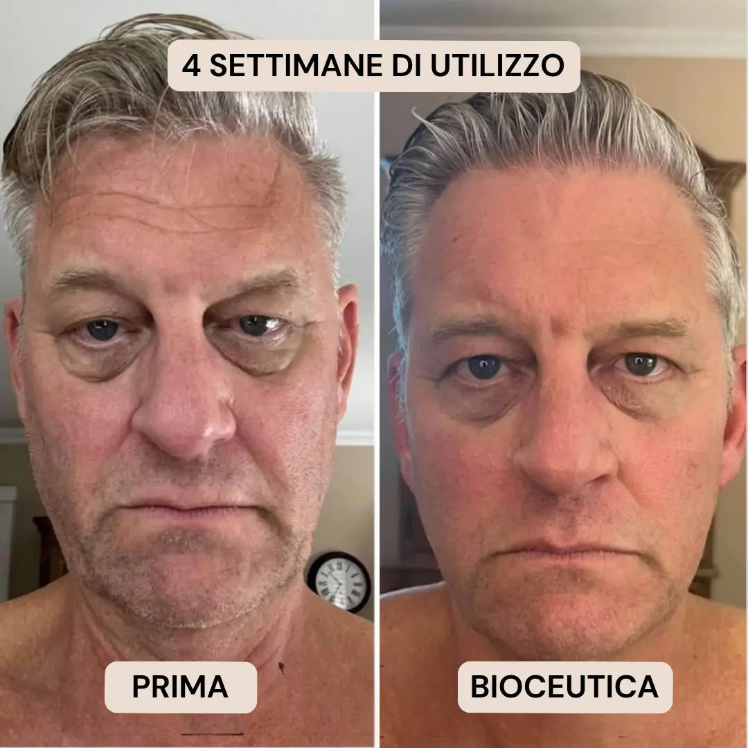 BioInfusion+ | Sistema di Microinfusione (Uomo)