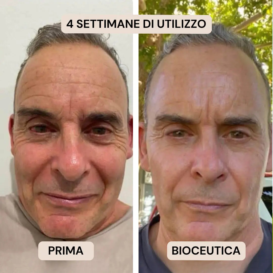 BioInfusion+ | Sistema di Microinfusione (Uomo)