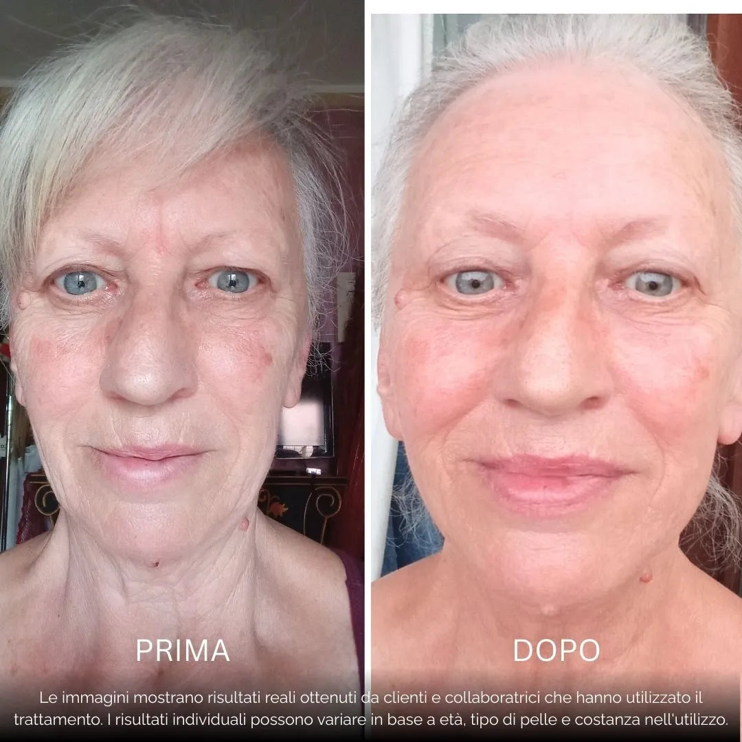 BioInfusion+ | Sistema di Microinfusione (Dear Alice)