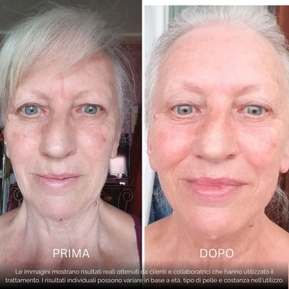 BioInfusion+ | Sistema di Microinfusione (Dear Alice)