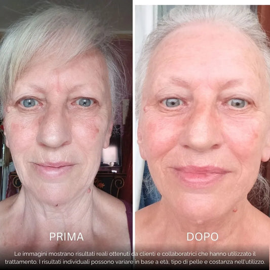 BioInfusion+ | Sistema di Microinfusione