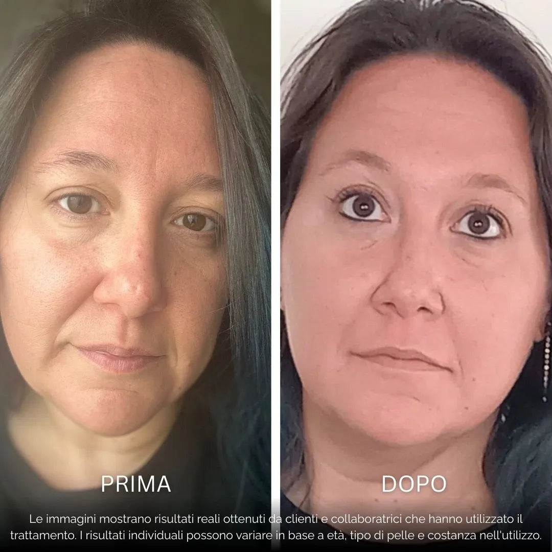 BioInfusion+ | Sistema di Microinfusione (Dear Alice)