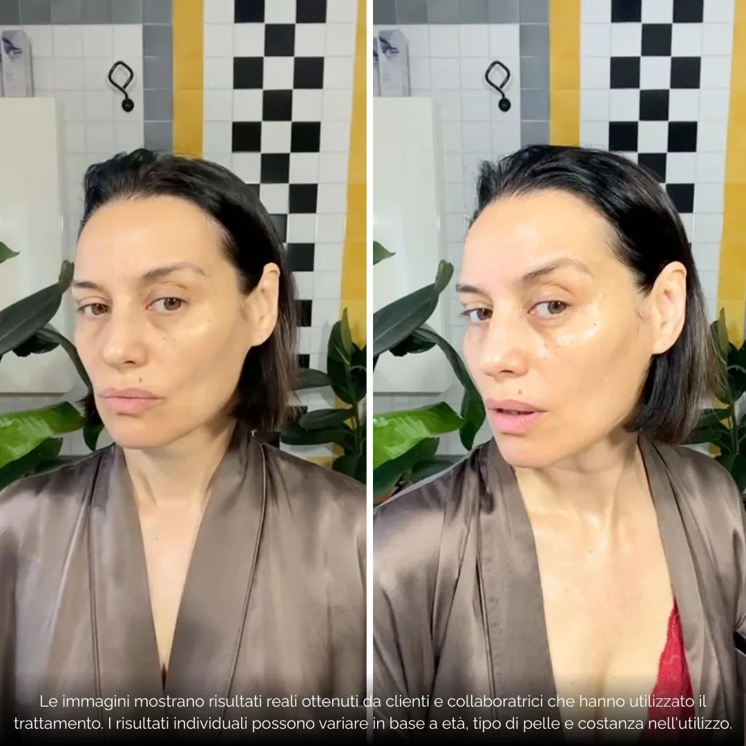 BioInfusion+ | Sistema di Microinfusione (Dear Alice)