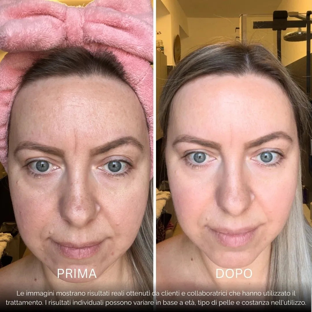 BioInfusion+ | Sistema di Microinfusione (Dear Alice)