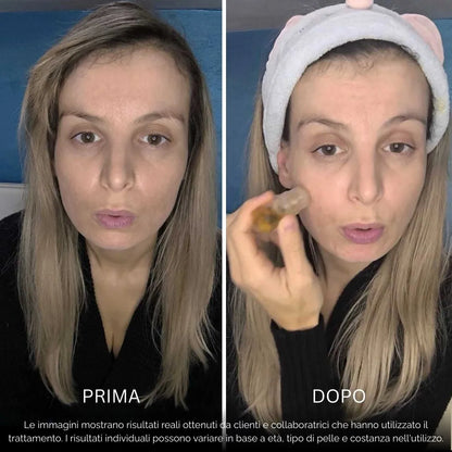 BioInfusion+ | Sistema di Microinfusione (Dear Alice)