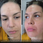 BioInfusion+ | Sistema di Microinfusione