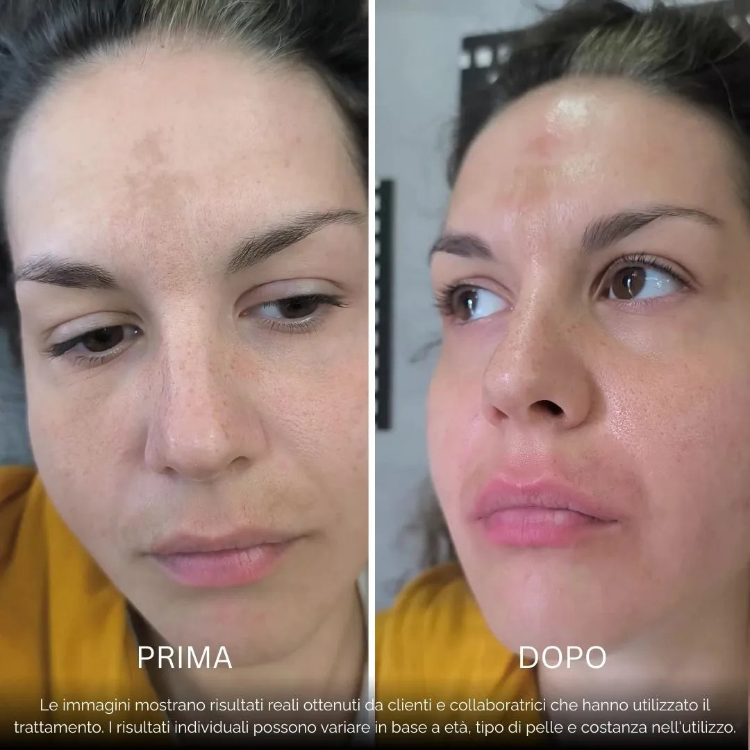 BioInfusion+ | Sistema di Microinfusione