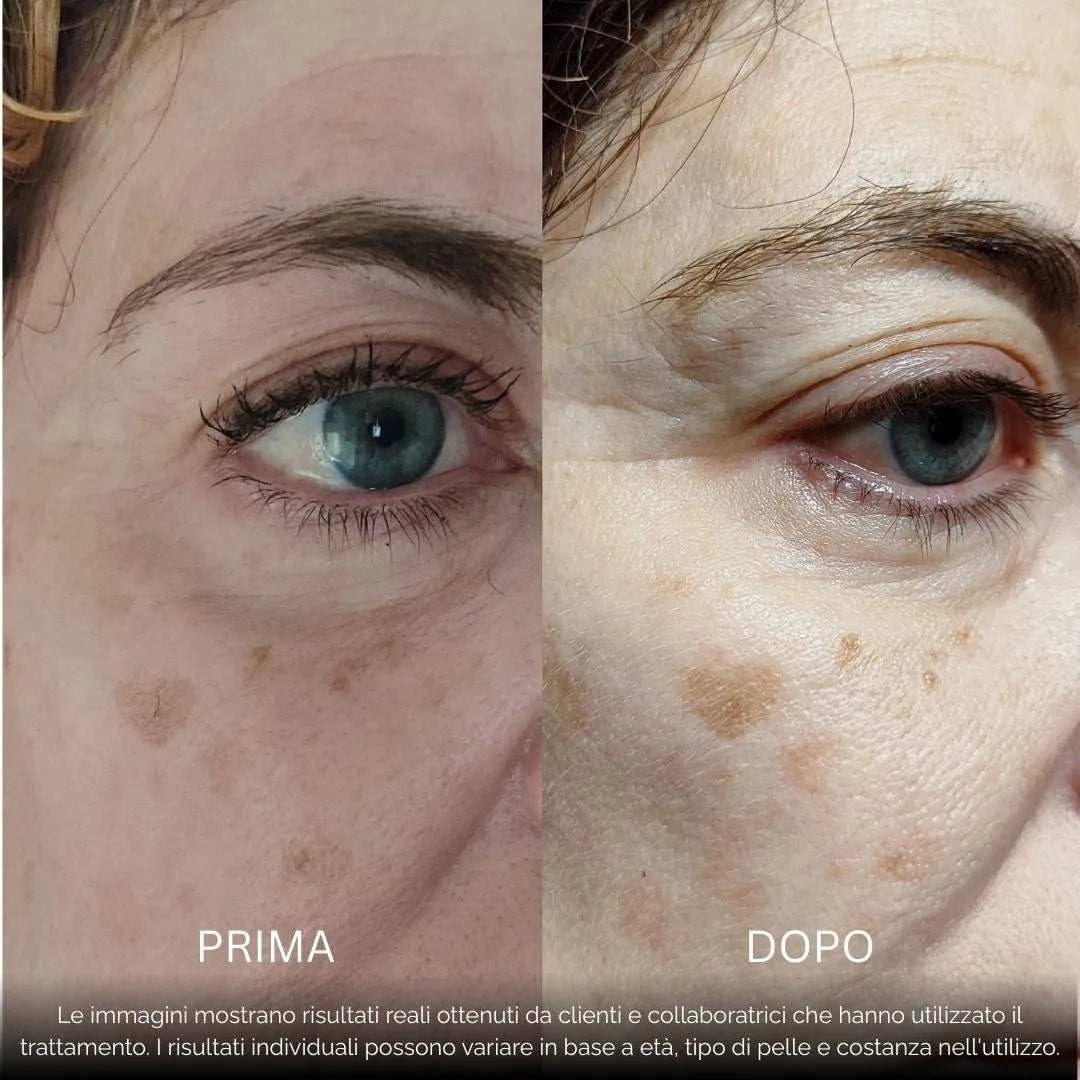 BioInfusion+ | Sistema di Microinfusione (Dear Alice)