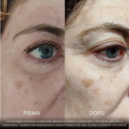 BioInfusion+ | Sistema di Microinfusione (Dear Alice)