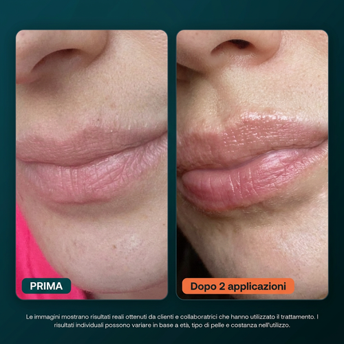 BioVolume+ Microinfusione Labbra — 02