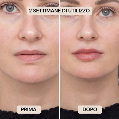 BioVolume+ | Microinfusione Labbra