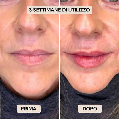 BioVolume+ | Microinfusione Labbra
