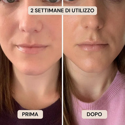 BioVolume+ | Microinfusione Labbra