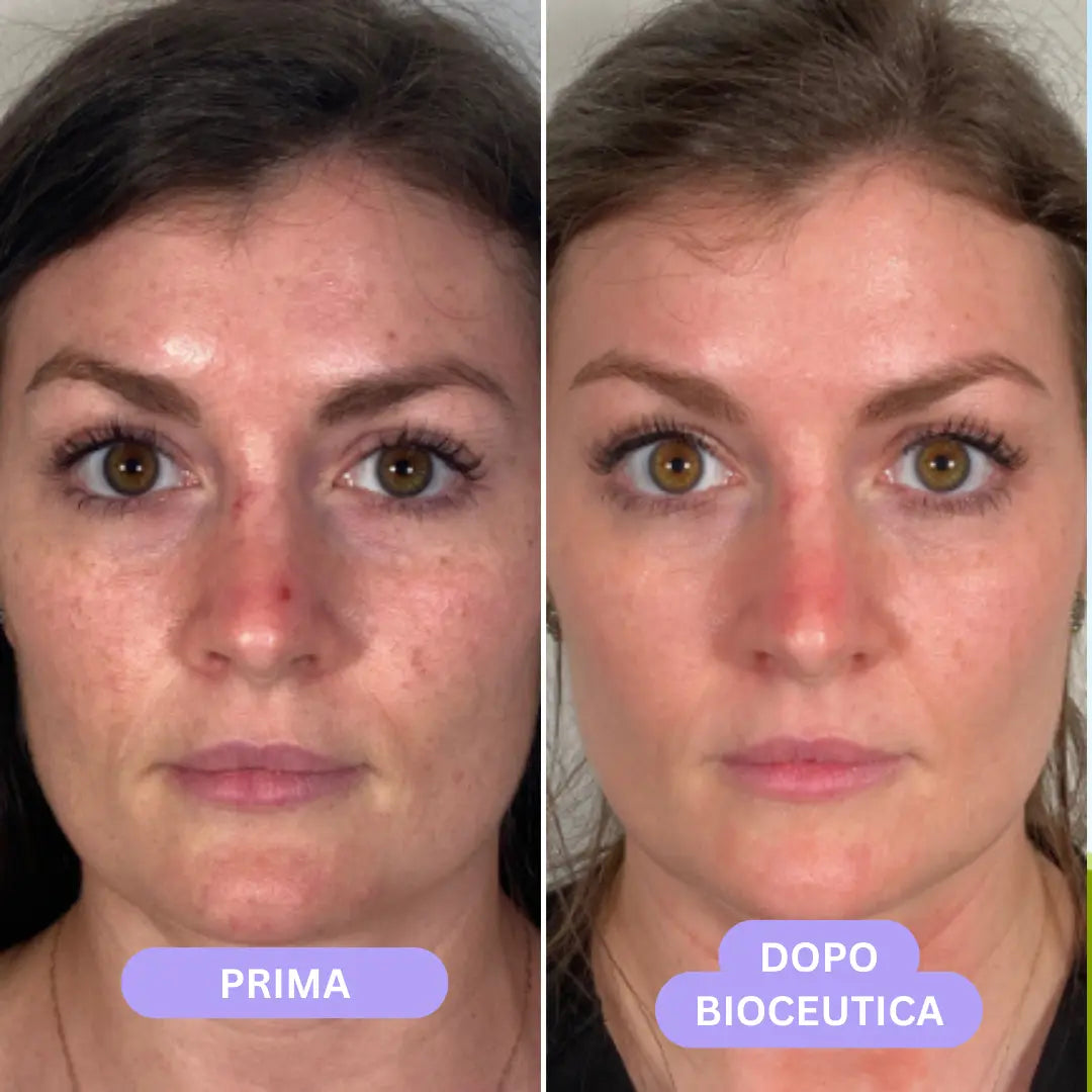 Bioceutica Milano Sistema di Infusione Microneedling – Anti-Age, Ringiovanimento Cutaneo, Microaghi in Oro 24K