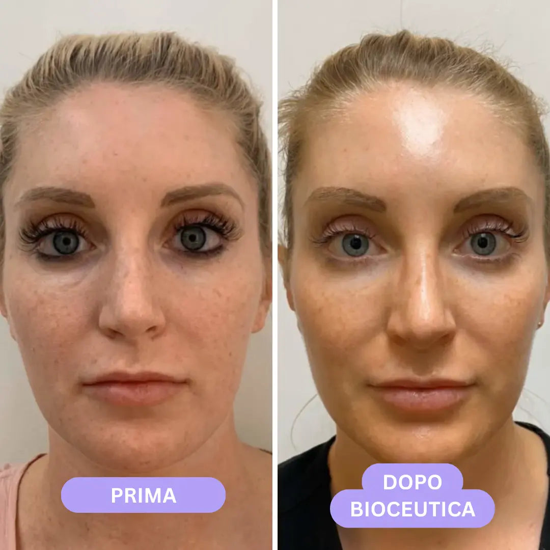 Bioceutica Milano Sistema di Infusione Microneedling – Anti-Age, Ringiovanimento Cutaneo, Microaghi in Oro 24K
