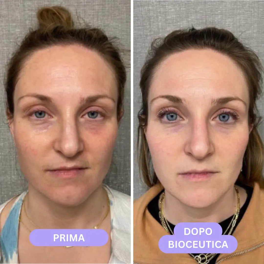 Bioceutica Milano Sistema di Infusione Microneedling – Anti-Age, Ringiovanimento Cutaneo, Microaghi in Oro 24K