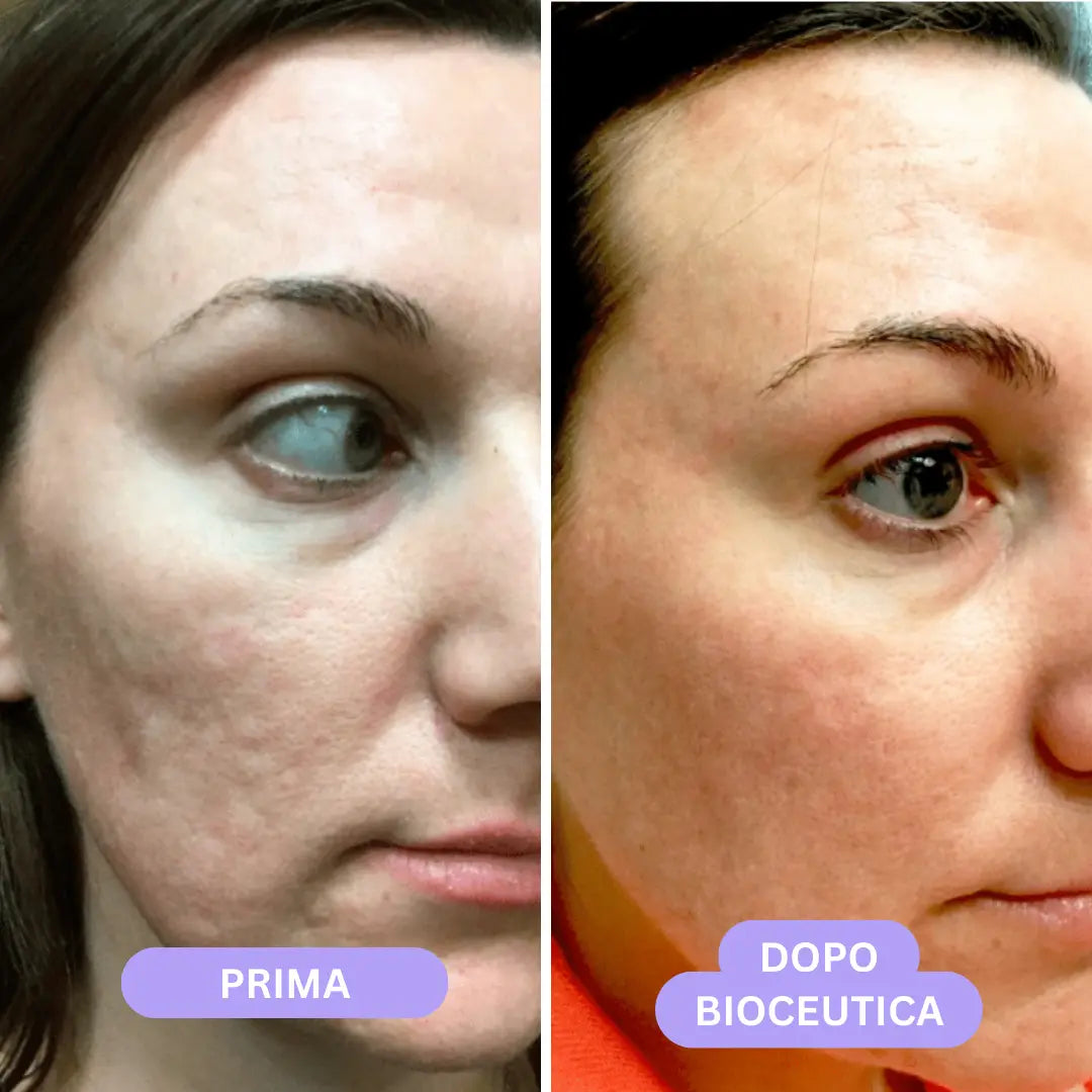 Bioceutica Milano Sistema di Infusione Microneedling – Anti-Age, Ringiovanimento Cutaneo, Microaghi in Oro 24K