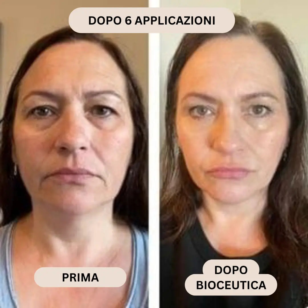 BioInfusion+ | Sistema di Microinfusione
