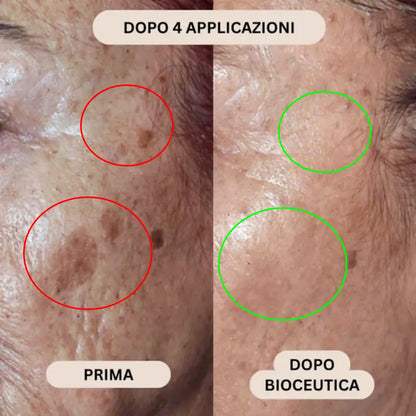 BioInfusion+ | Sistema di Microinfusione