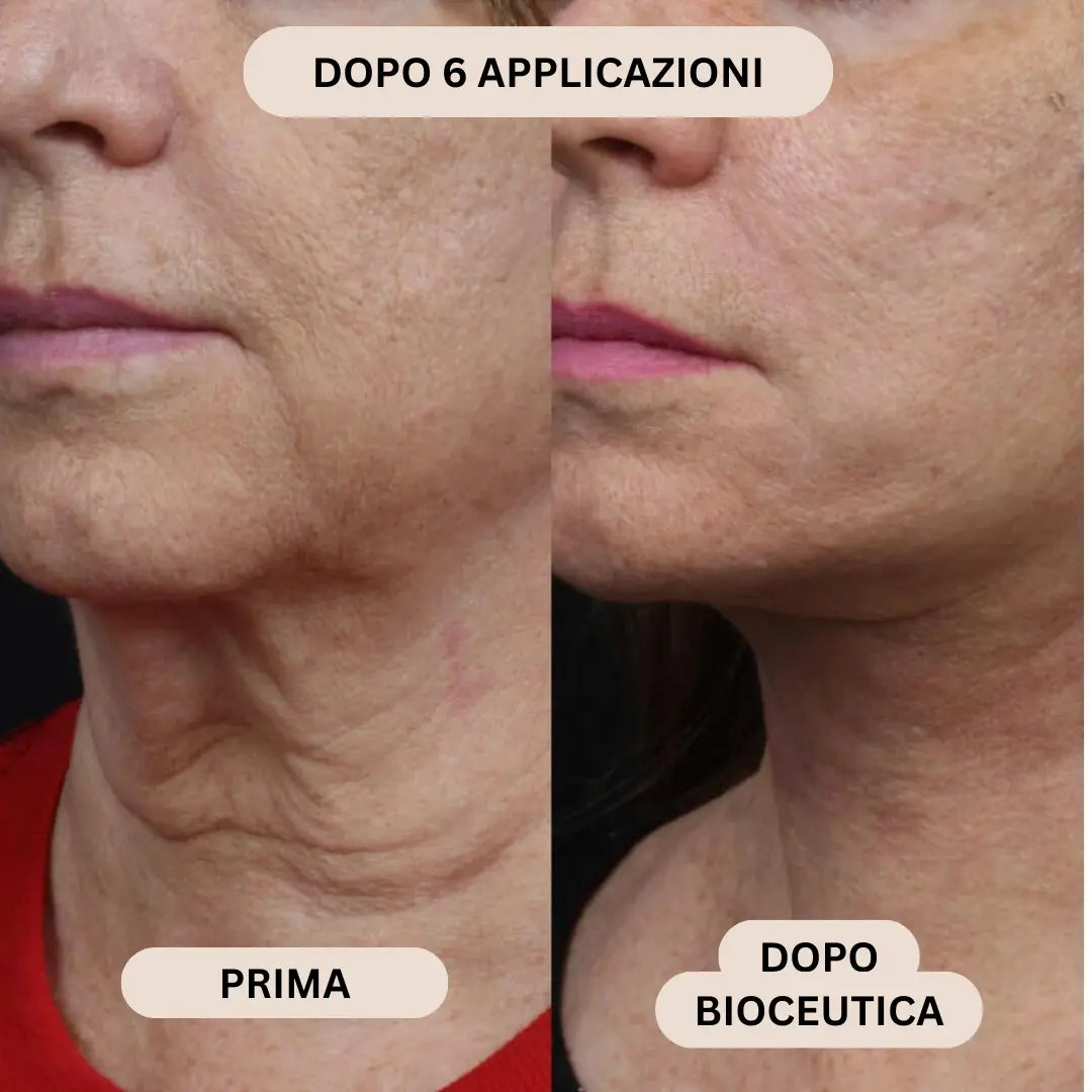 BioInfusion+ | Sistema di Microinfusione